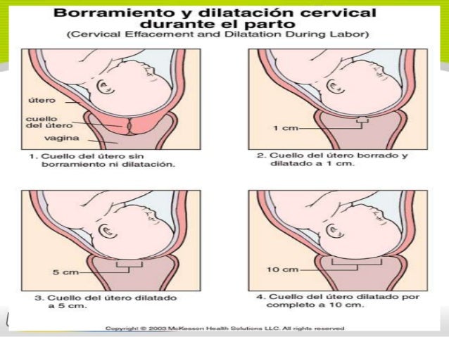 borramiento y dilatacion cervical durante el parto